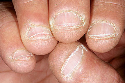 dấu hiệu bệnh qua móng tay - hình minh họa 9