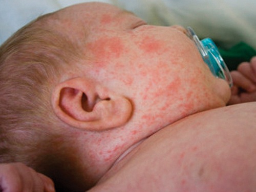 bệnh sởi quai bị rubella