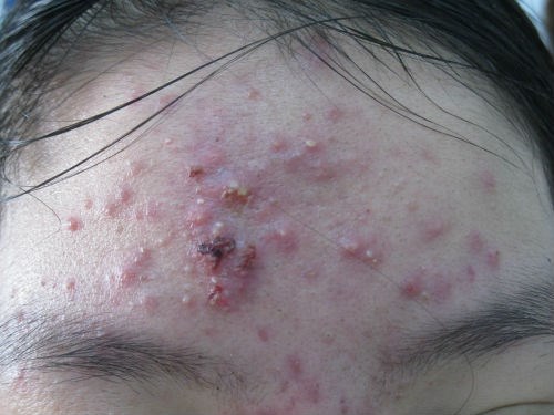 điều trị mụn trứng cá