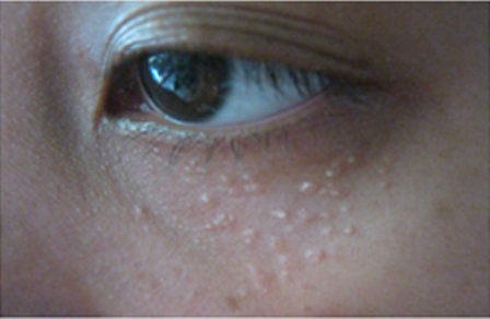 cách trị mụn thịt