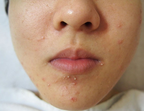 mụn trứng cá
